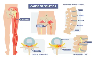 Ilustração das causas de dor ciática: hérnia de disco, estenose e síndrome do piriforme